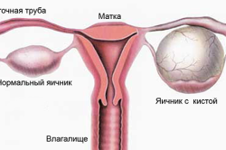 Апоплексия яичника