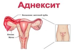 Схема аднексита