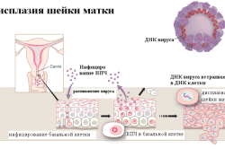 Дисплазия шейки матки 
