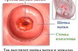 Польза боровой матки при эрозии 