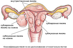 Разновидности миомы матки