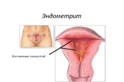 Эндометрит