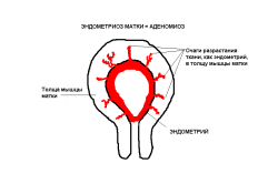 Схема аденомиоза матки