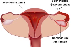 Эндометрит