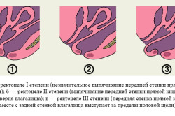 Степени ректоцеле