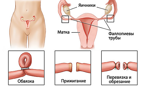 Проведение удаления маточной трубы