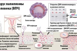 Вирус папилломы человека (ВПЧ) - одна из причин рака шейки матки