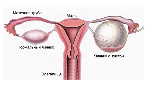 Яичник здоровый и больной
