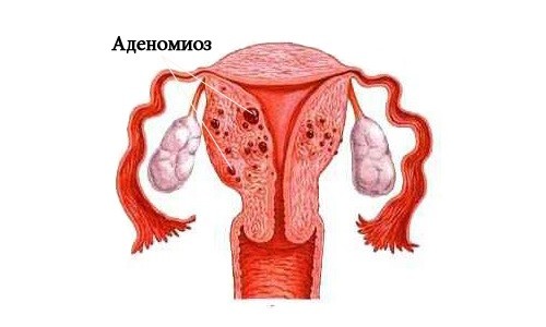 Схема аденомиоза матки