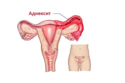 Схема аднексита