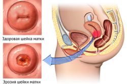 Эрозия шейки матки 
