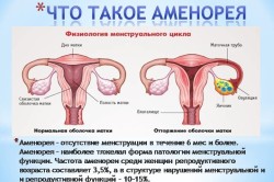 Аменорея