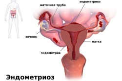 Эндометриоз