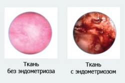 Ткань, пораженная эндометриозом