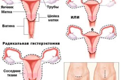 Виды гистерэктомии