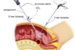 Принцип лапароскопии
