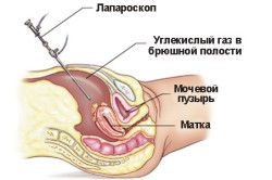 Лапароскопия матки