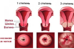Схема лейкоплакии шейки матки