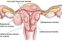 Миома матки - причина маточного кровотечения