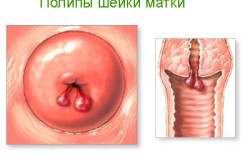Схема полипов шейки матки