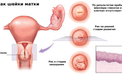 Стадии рака шейки матки