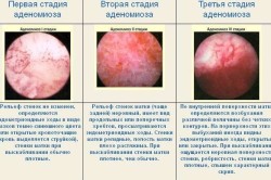 Стадии аденомиоза матки