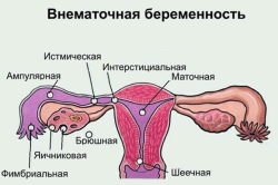 Внематочная беременность - причина болей в груди и задержки месячных