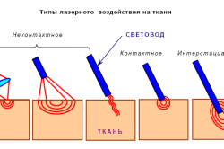 Типы лазерного воздействия на ткани