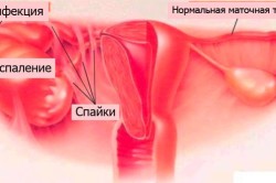 Схема двухстороннего сальпингоофорита