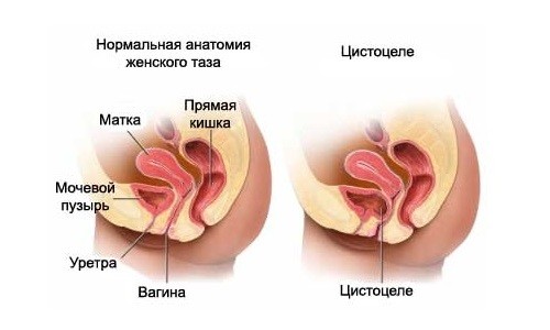 Симптомы и лечение цистоцеле мочевого пузыря