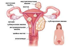 Миома матки