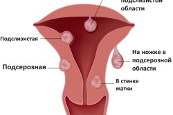 Миомы матки